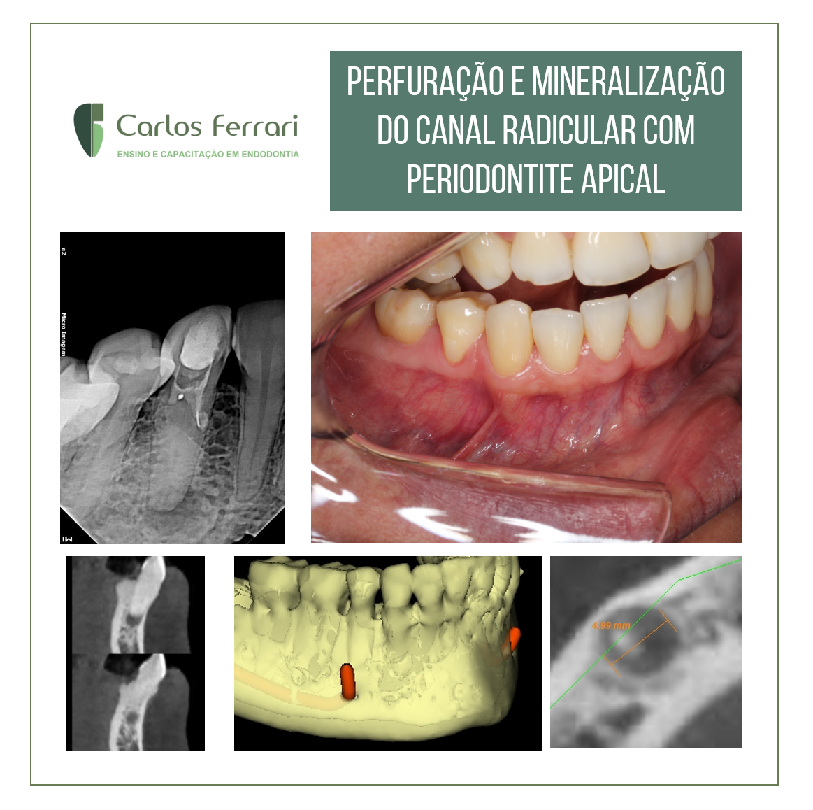 Perfuração, canal radicular obliterado e periodontite apical assintomática.