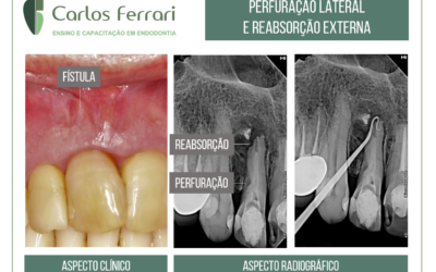 Perfuração radicular e reabsorção radicular externa.