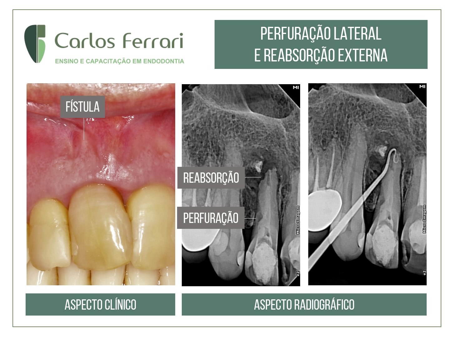 Perfuração radicular e reabsorção radicular externa.