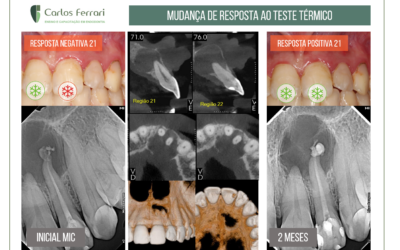 Teste de vitalidade pulpar positivo modificado após tratamento endodôntico.
