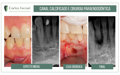 Cirurgia paraendodôntica em canal calcificado.