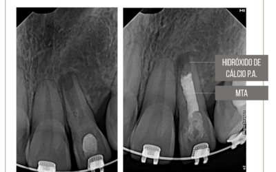 Apicificação em dente com rizogênese incompleta.