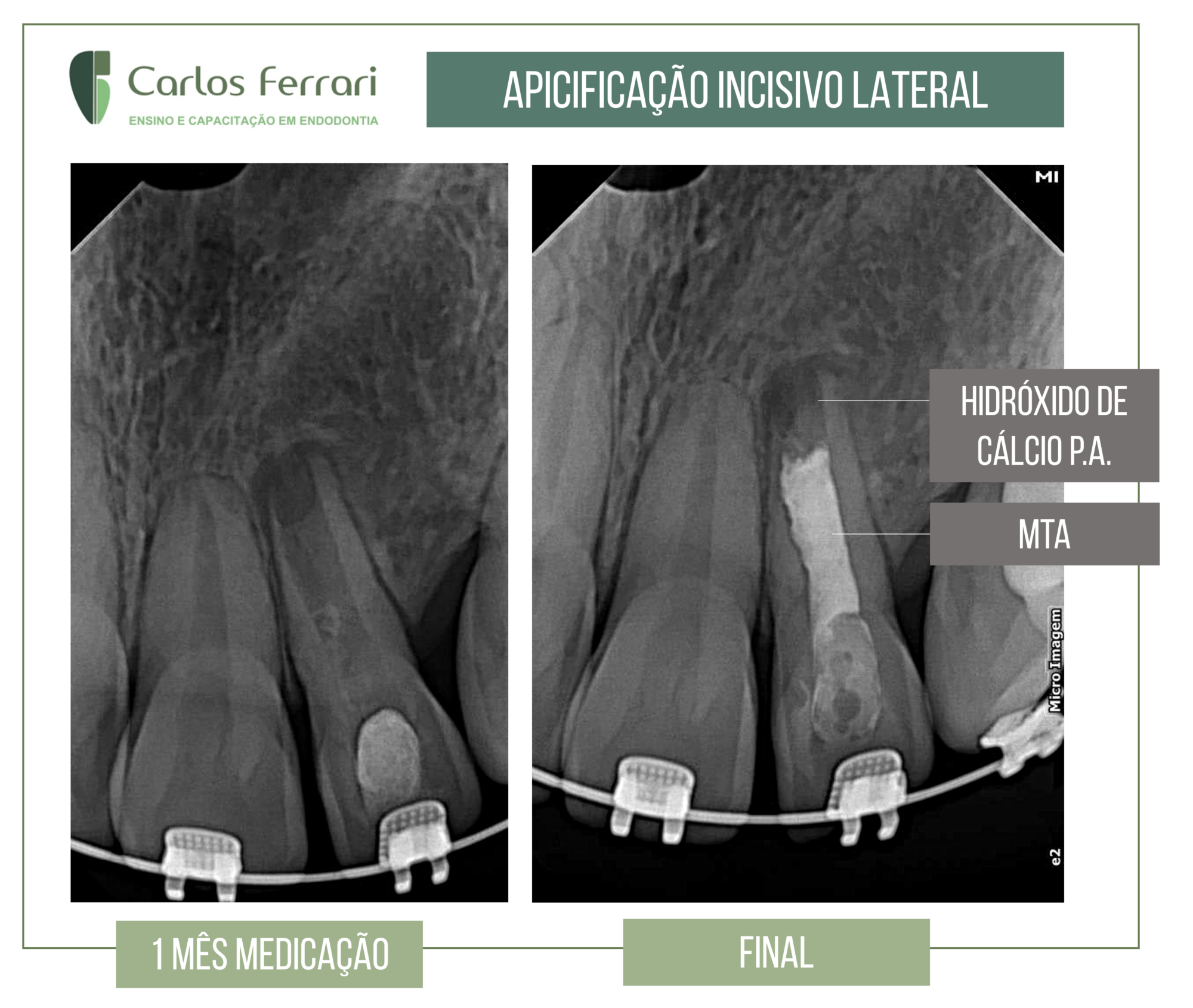Apicificação em dente com rizogênese incompleta.