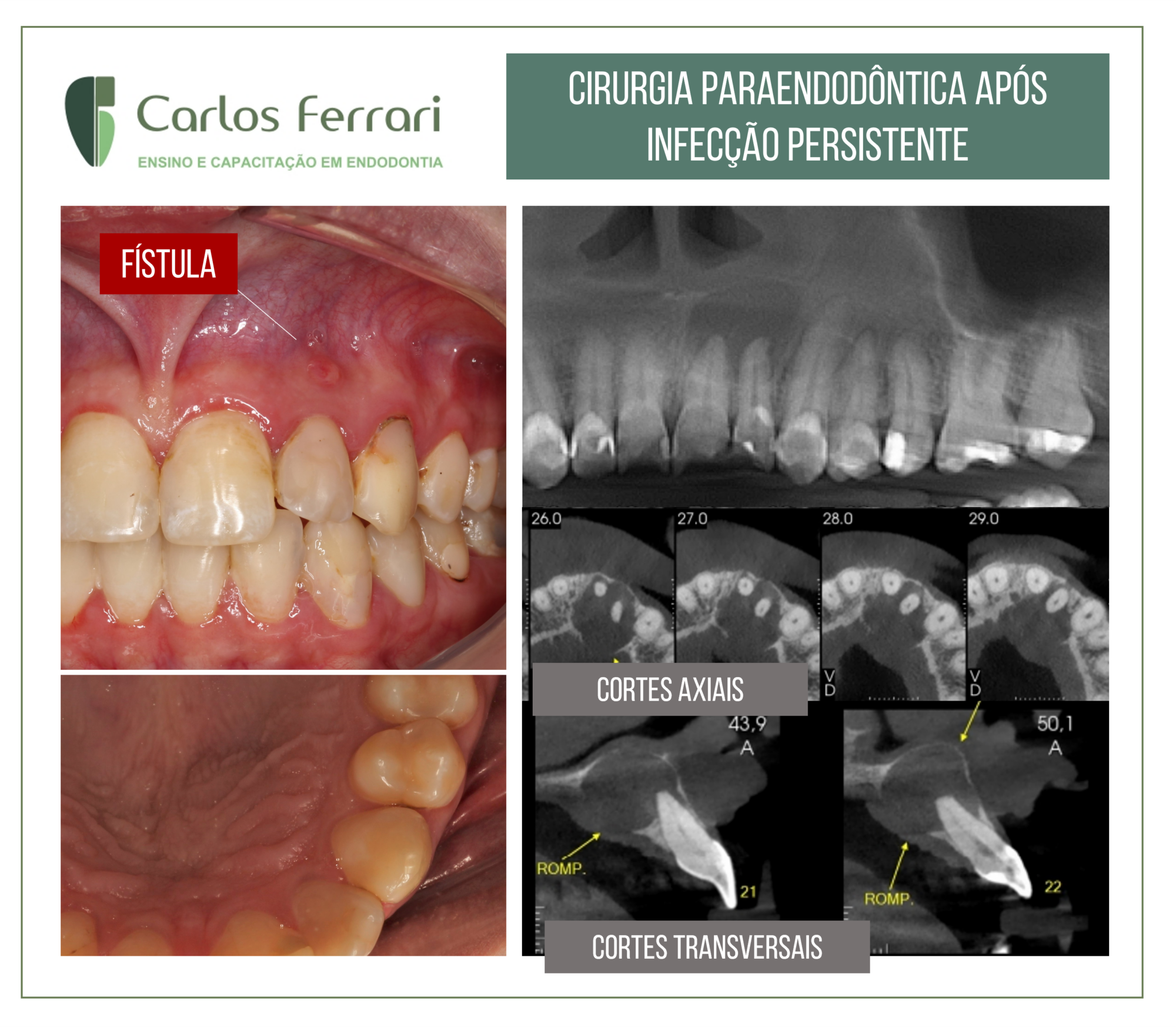 Cirurgia paraendodôntica após infecção persistente em dente com lesão periapical.