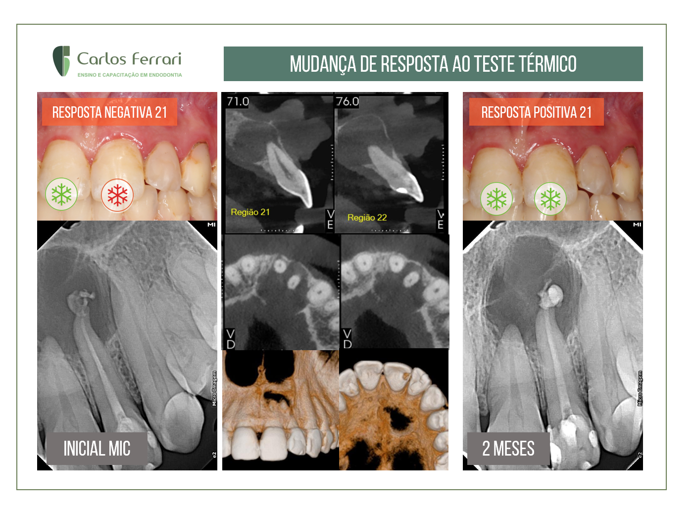 Teste de vitalidade pulpar positivo modificado após tratamento endodôntico.