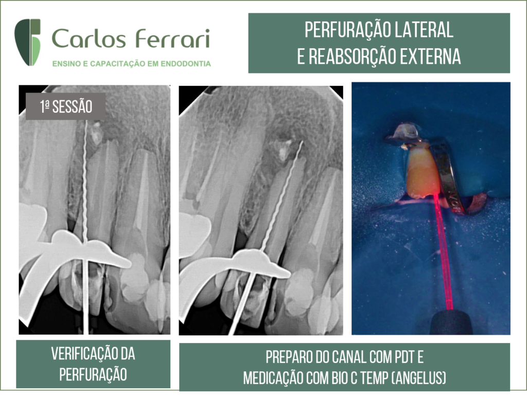 Perfuração radicular e reabsorção radicular externa.