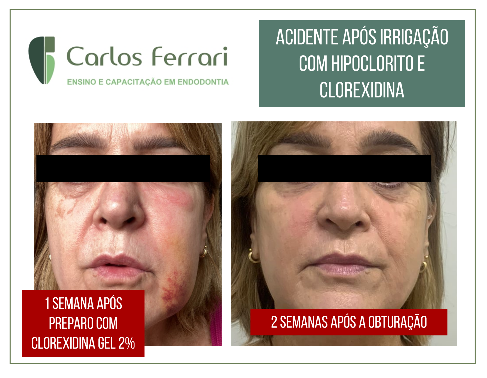 Irrigação na endodontia. Acidente com hipoclorito e clorexidina.