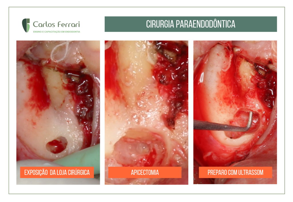 Perfuração, canal radicular obliterado e periodontite apical assintomática.