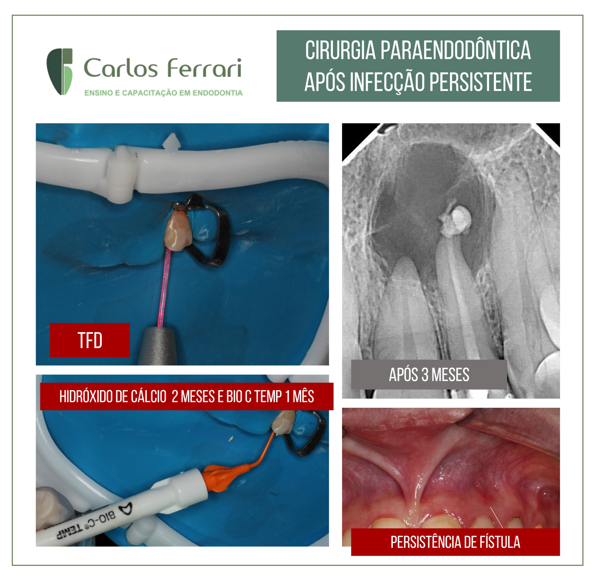 Cirurgia paraendodôntica após infecção persistente em dente com lesão periapical.
