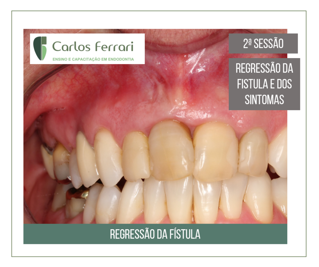 Perfuração radicular e reabsorção radicular externa.