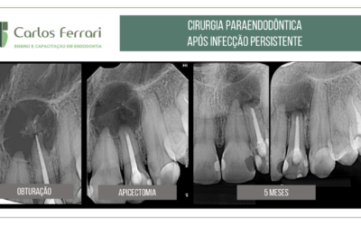 Cirurgia paraendodôntica após infecção persistente em dente com lesão periapical.