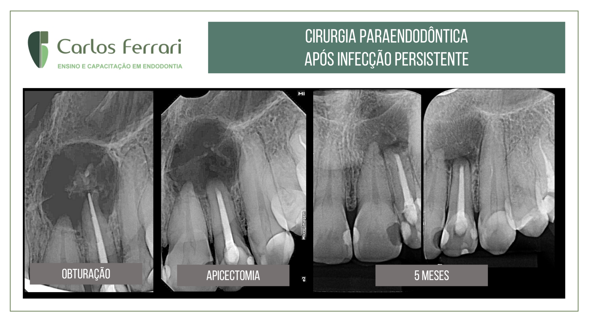 Cirurgia paraendodôntica após infecção persistente em dente com lesão periapical.