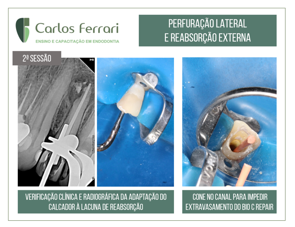 Perfuração radicular e reabsorção radicular externa.