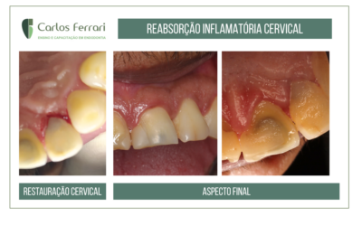 Reabsorção cervical externa. Tratamento endodôntico e cirúrgico.