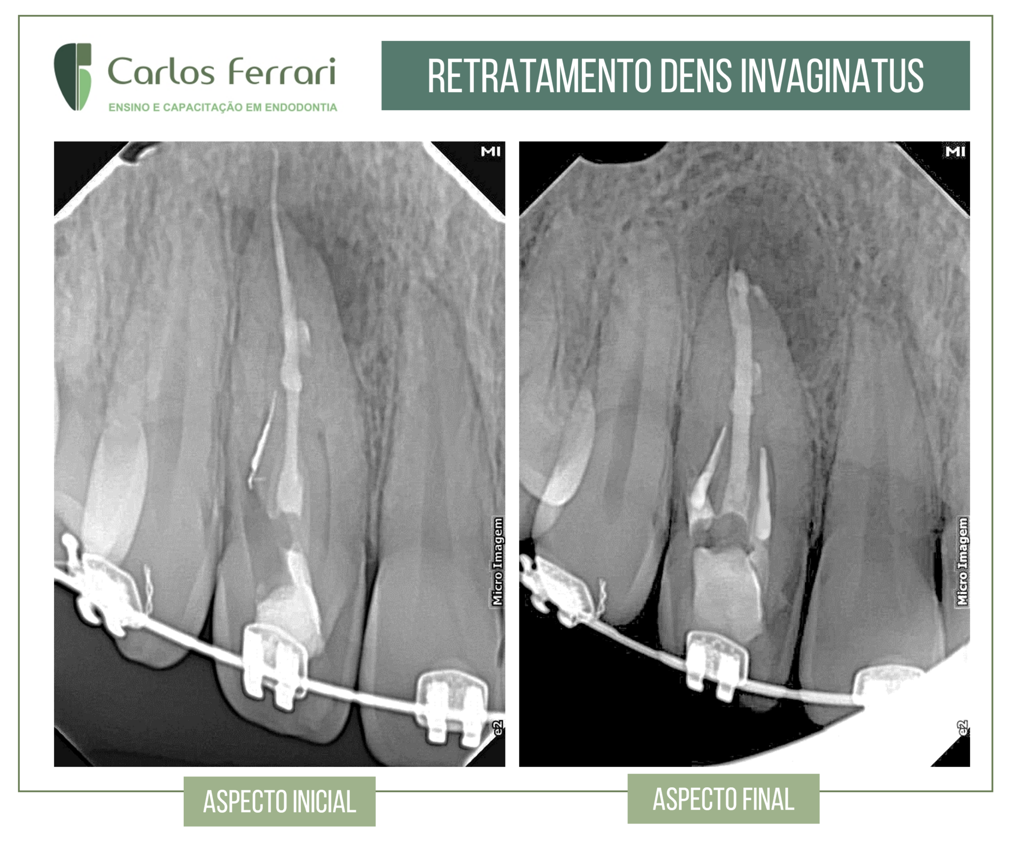 Retratamento de dens invaginatus com MTA. Endodontia.