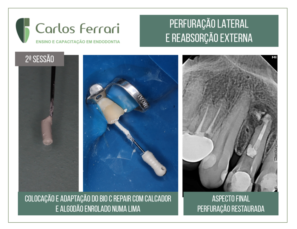 Perfuração radicular e reabsorção radicular externa.