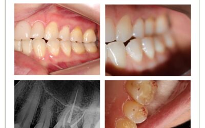 Inflamação pulpar reversível com causa oclusal.