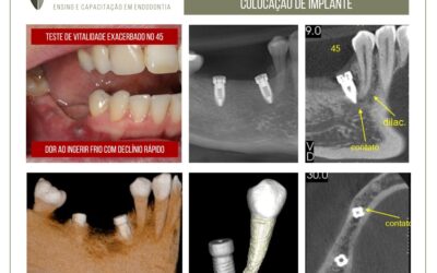 Inflamação pulpar reversível após a colocação de implante.