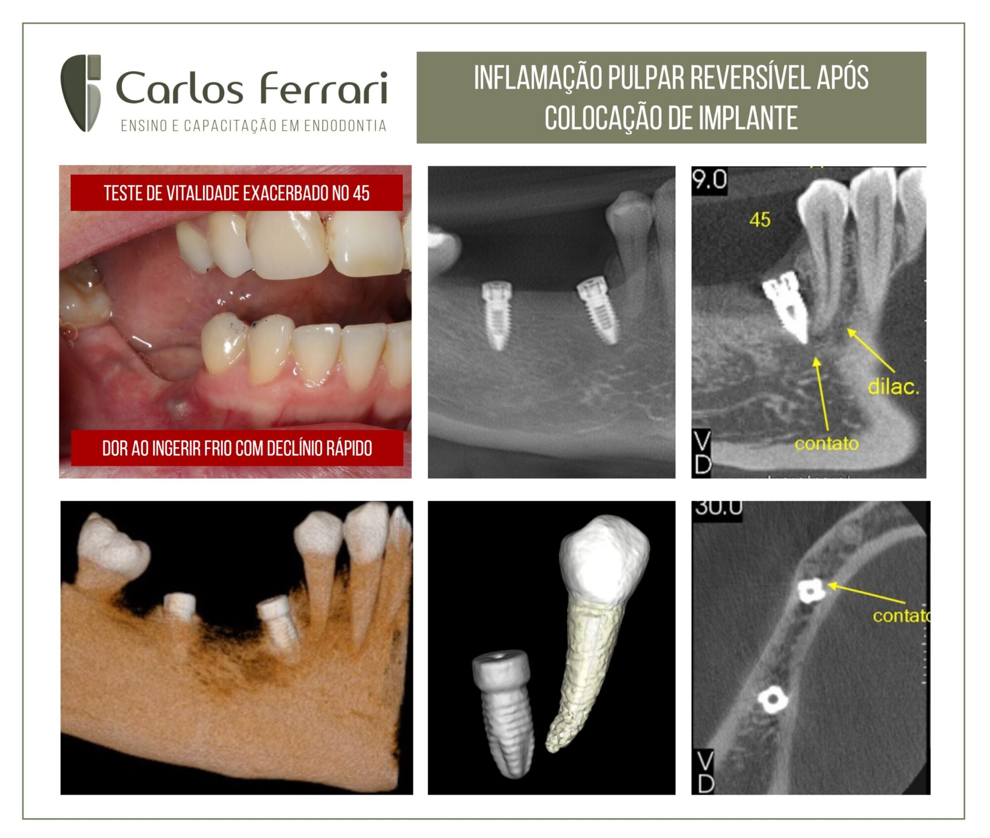 Inflamação pulpar reversível após a colocação de implante.