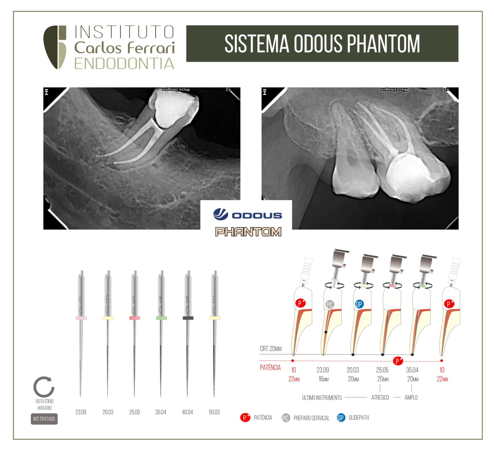 Lima Odous Phantom.Sistema de preparo endodôntico rotatório.