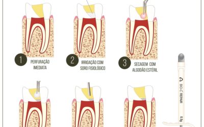 Cimento biocerâmico para capeamento pulpar.