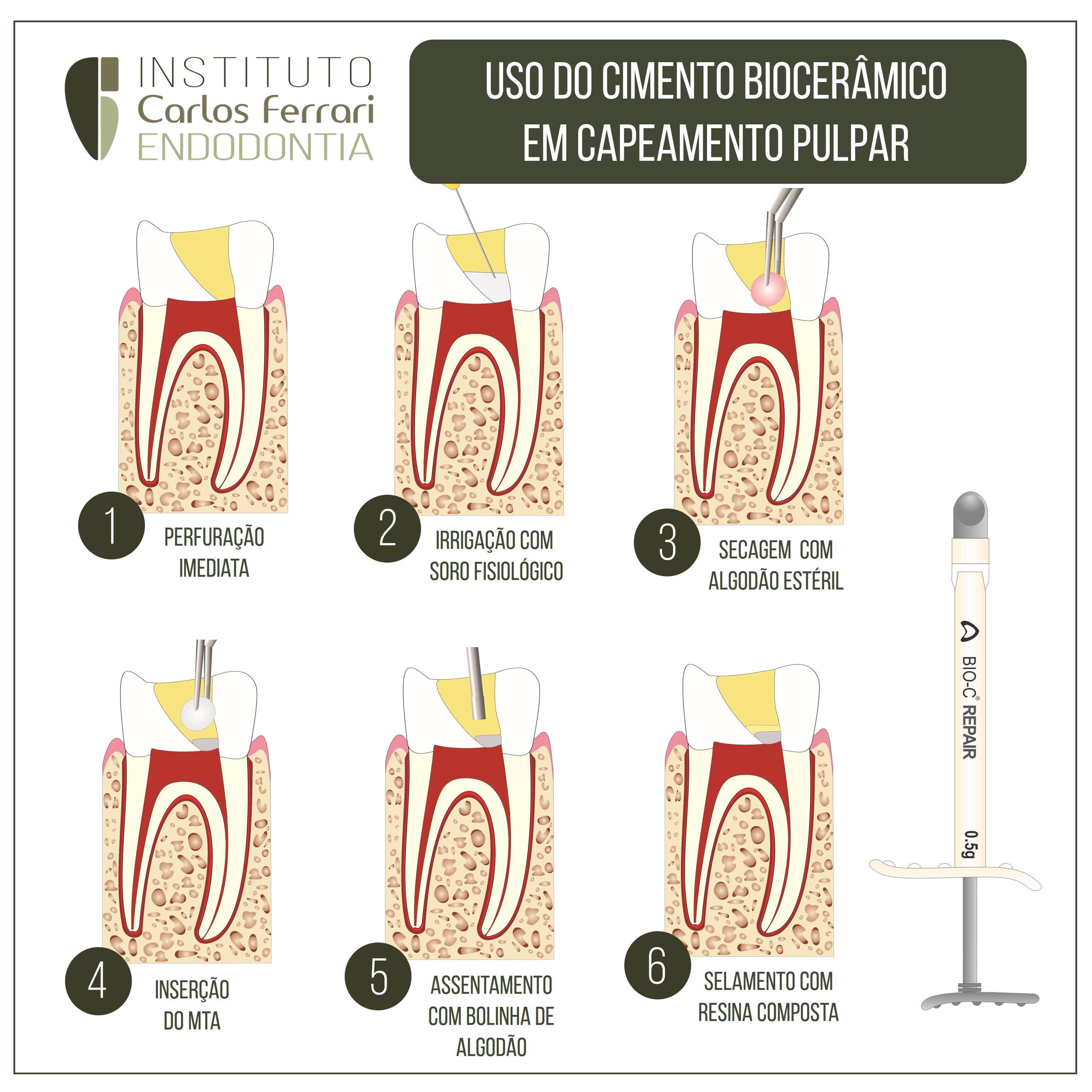 Cimento biocerâmico para capeamento pulpar.