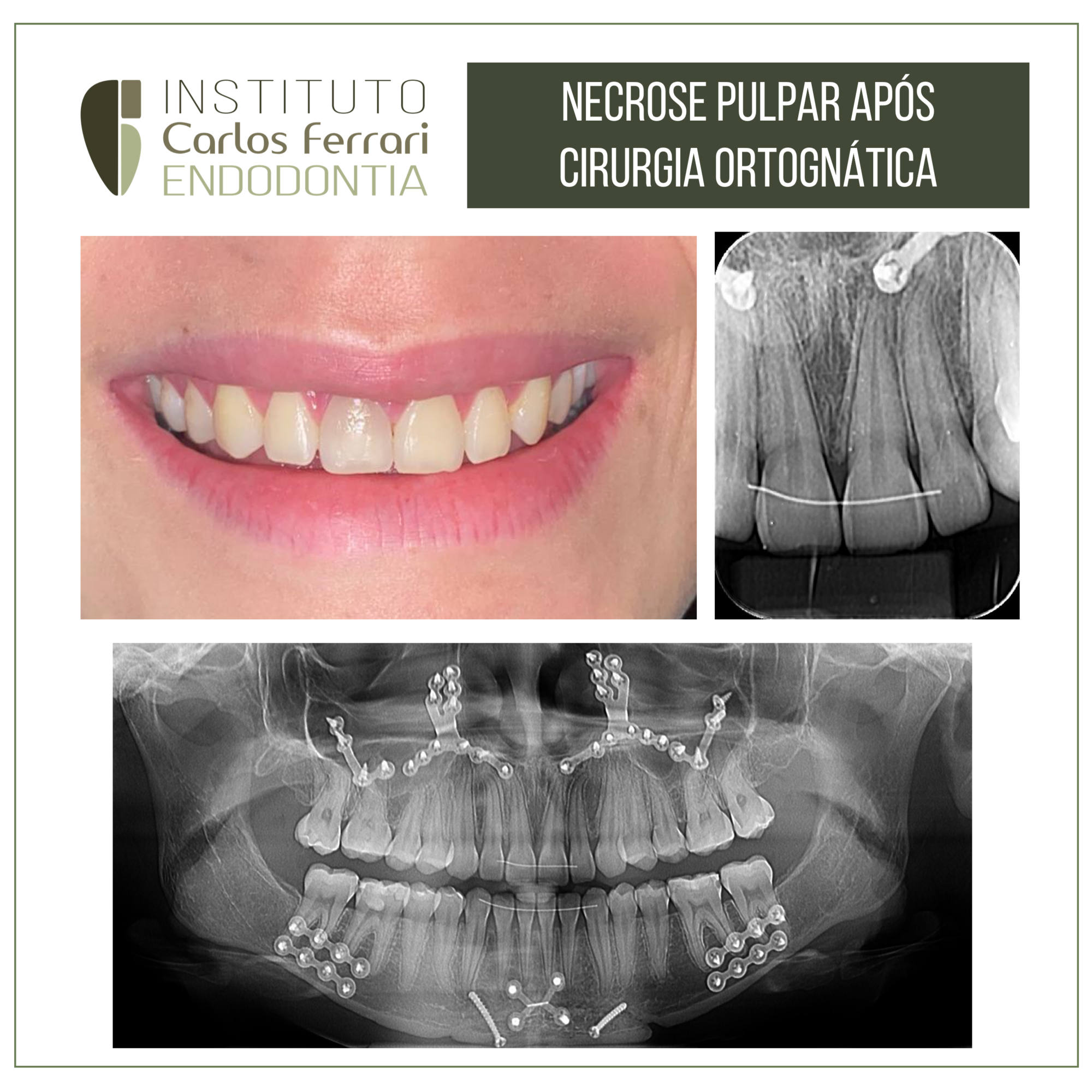 Necrose pulpar após cirurgia ortognática. Relato de caso.