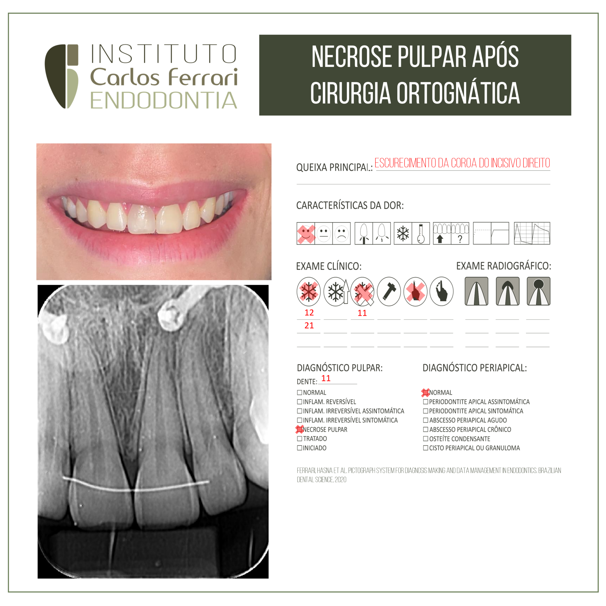 Necrose pulpar após cirurgia ortognática. Relato de caso.