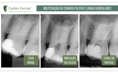 Canal calcificado em molar superior.