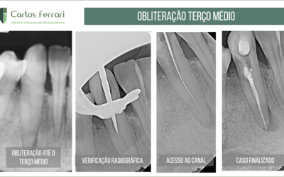 Lima manual em calcificação do canal radicular no terço médio.
