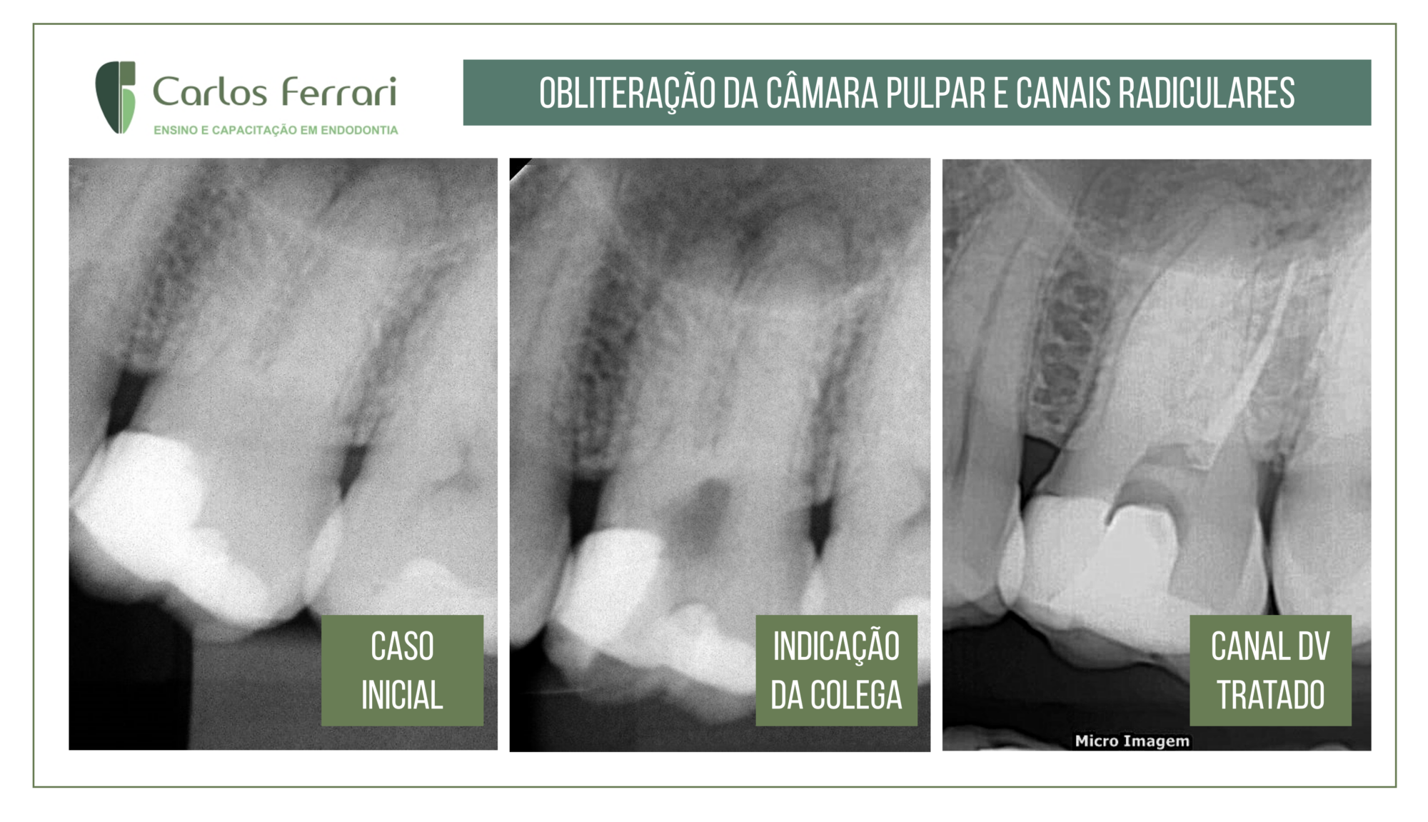 Canal calcificado em molar superior.