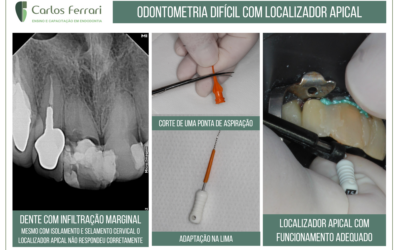 Odontometria com localizador apical de difícil execução.