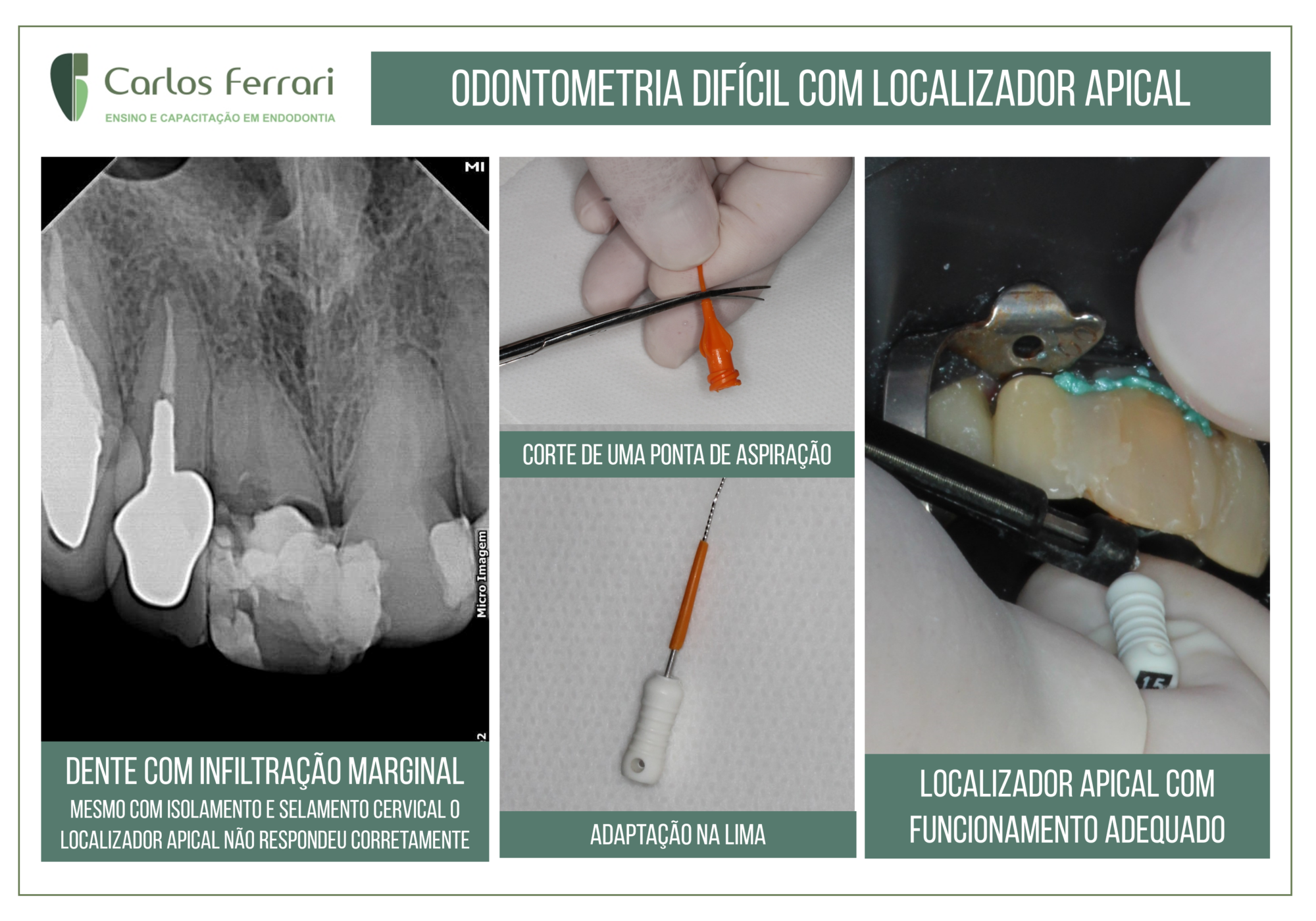 Odontometria com localizador apical de difícil execução.