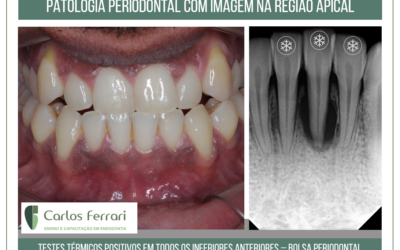 Lesão  periapical sem origem endodôntica.