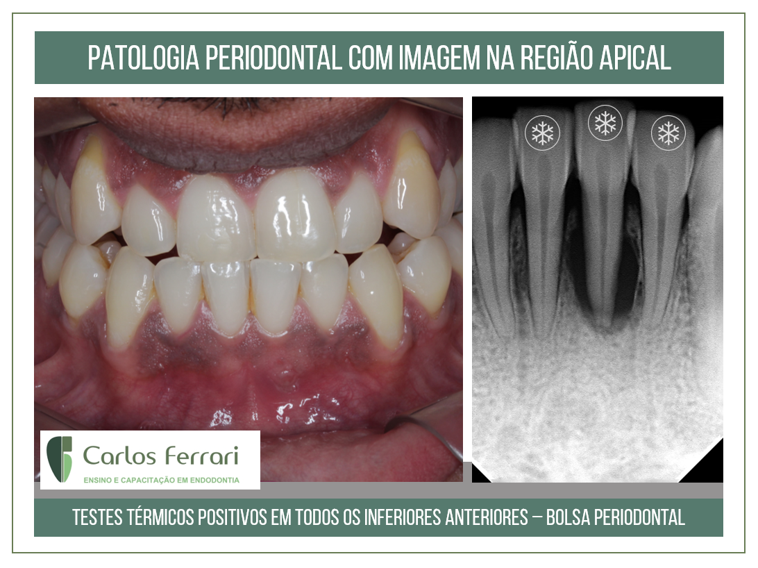 Lesão  periapical sem origem endodôntica.