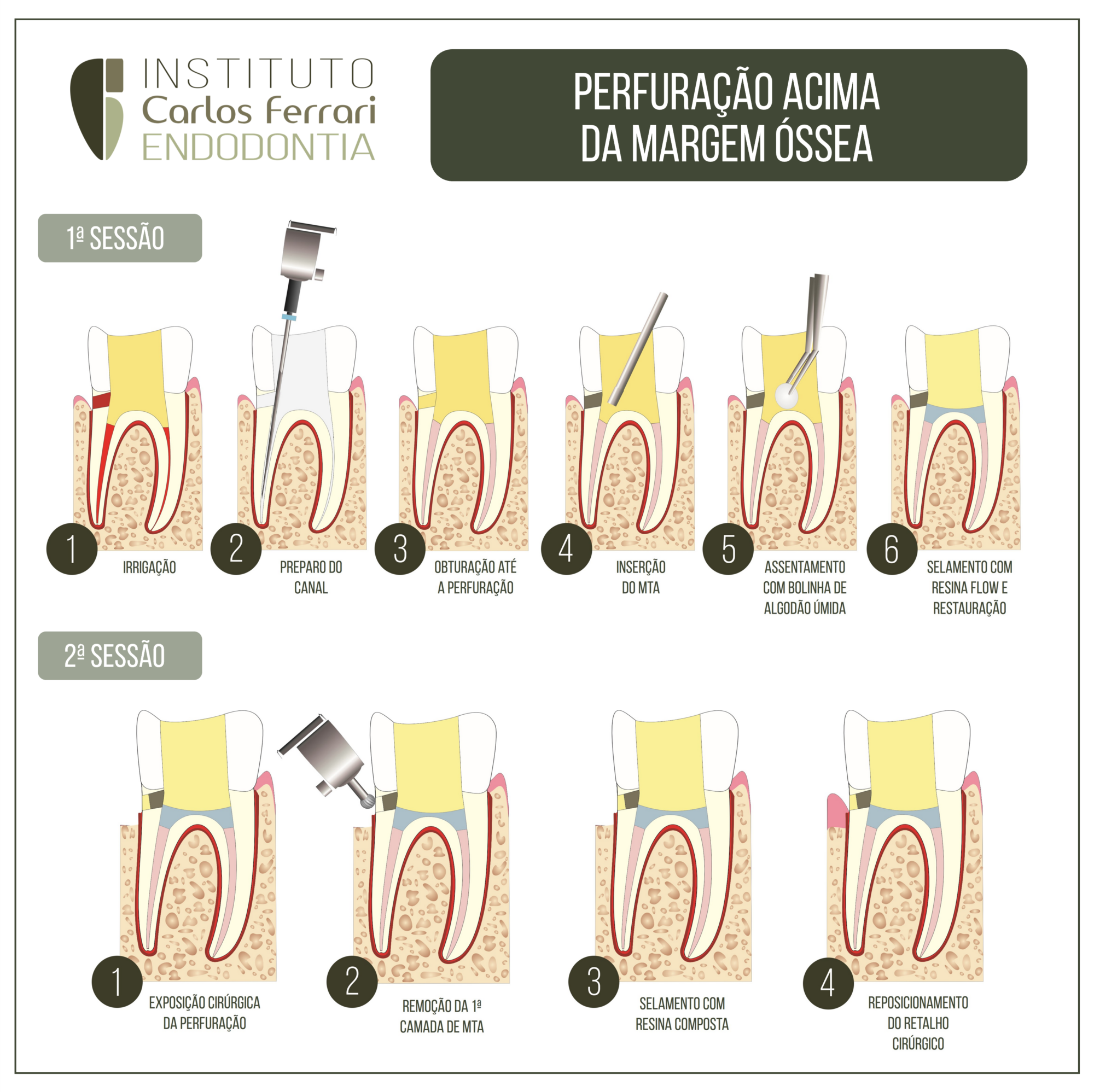 Perfuração lateral acima da margem óssea. O que fazer?