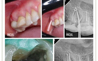 Perfuração de furca em molar. Selamento com MTA.