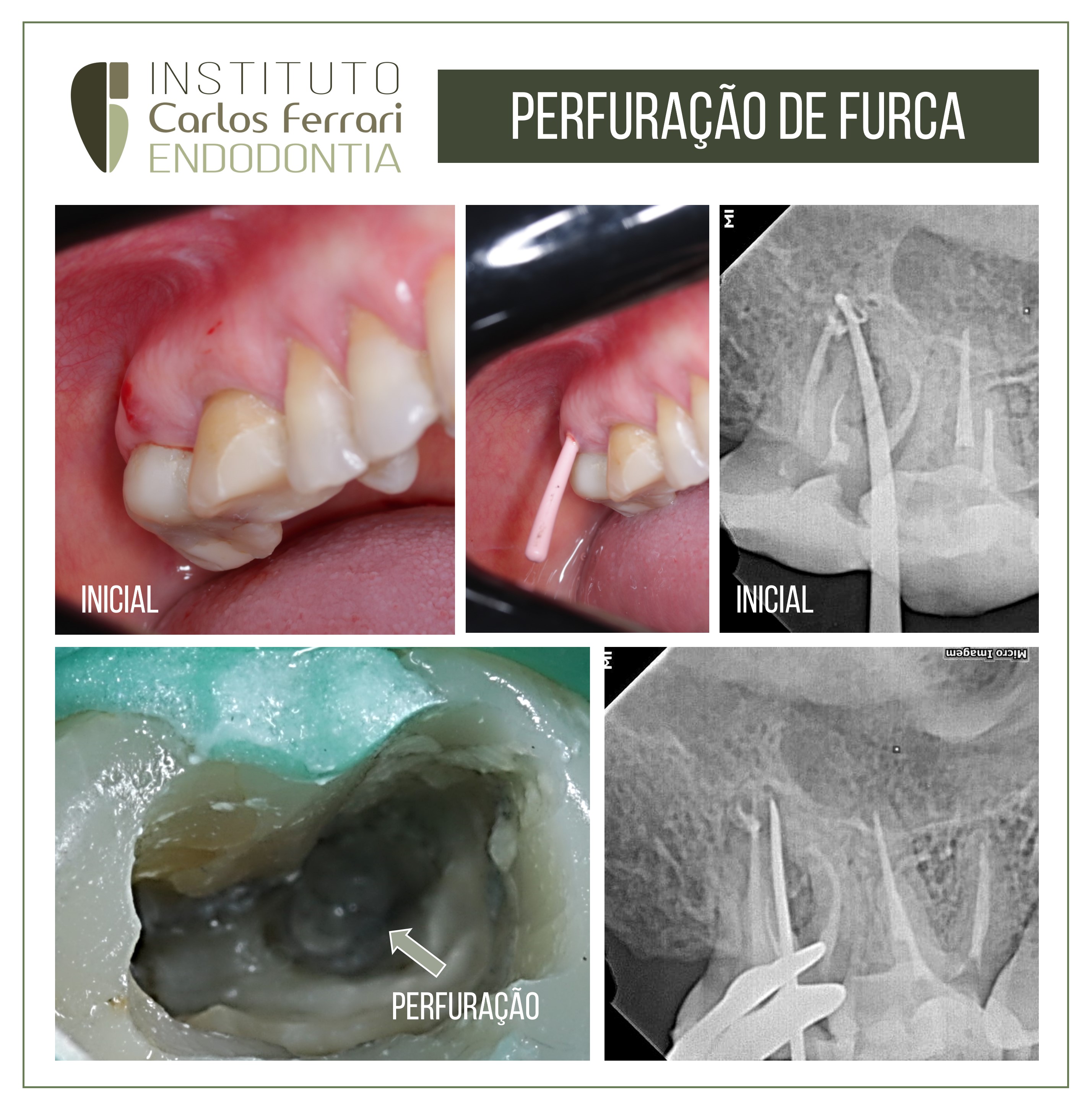 Perfuração de furca em molar. Selamento com MTA.