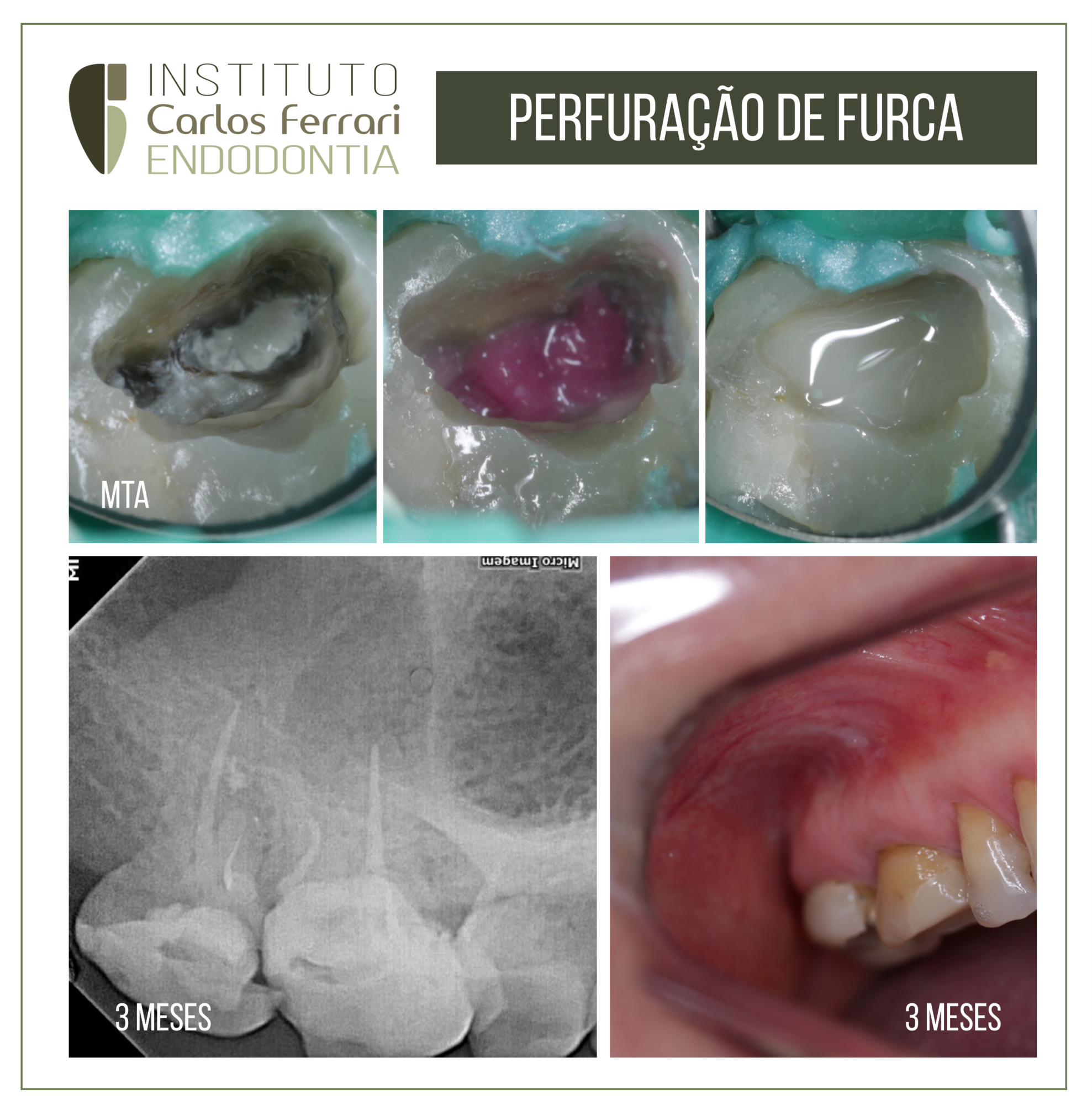 Perfuração de furca em molar. Selamento com MTA.