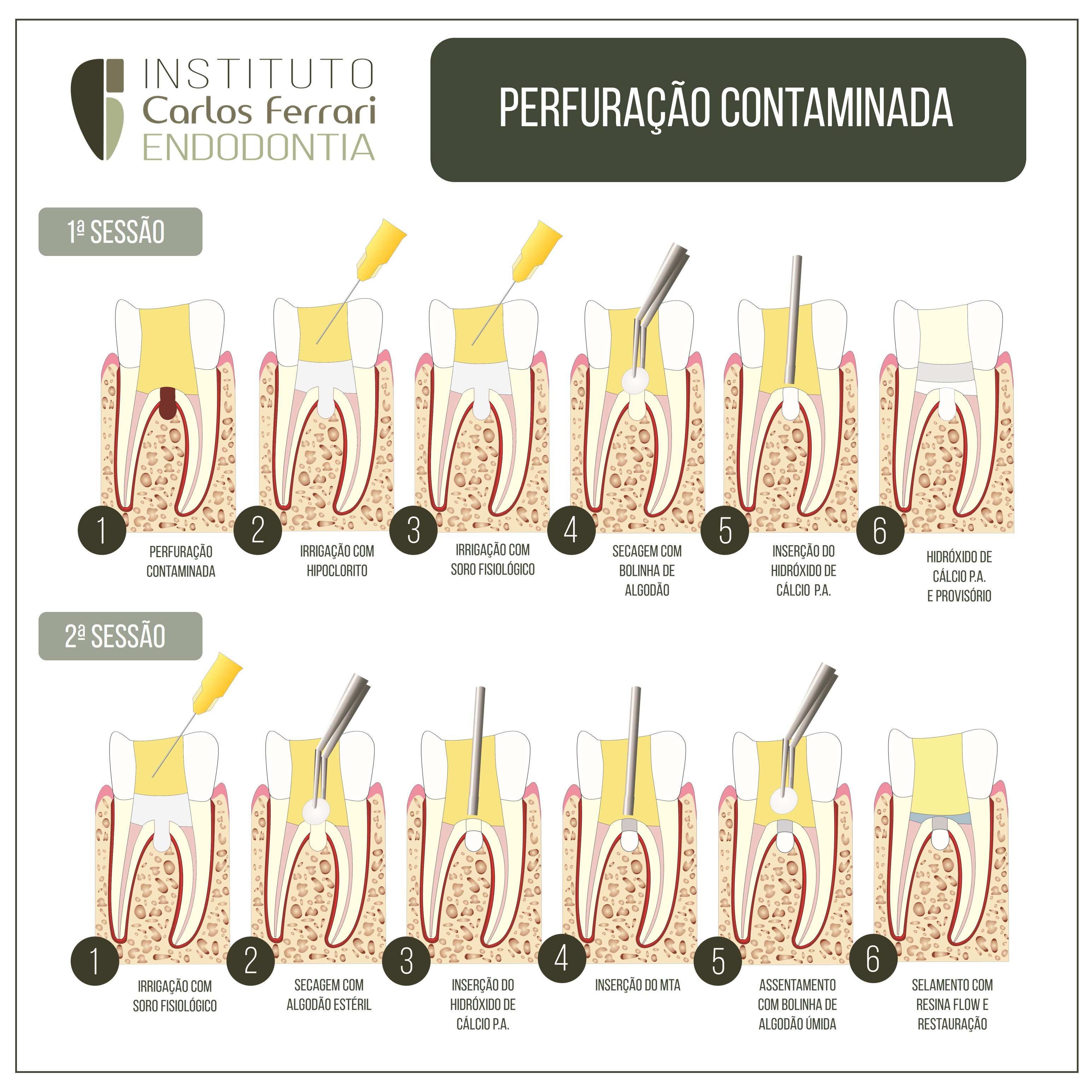 Perfuração radicular contaminada. O que fazer?