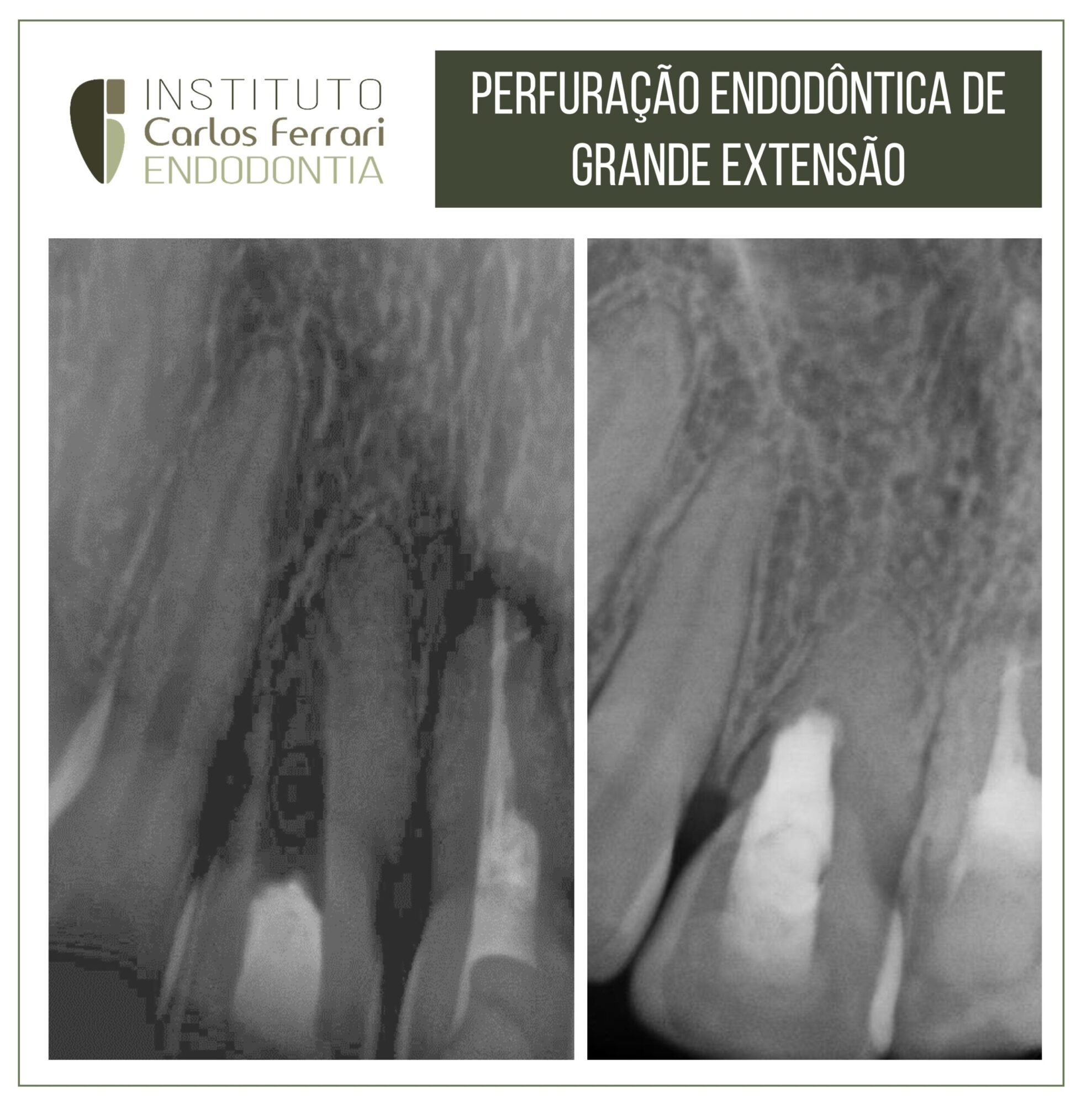 Perfuração endodôntica de grande extensão.