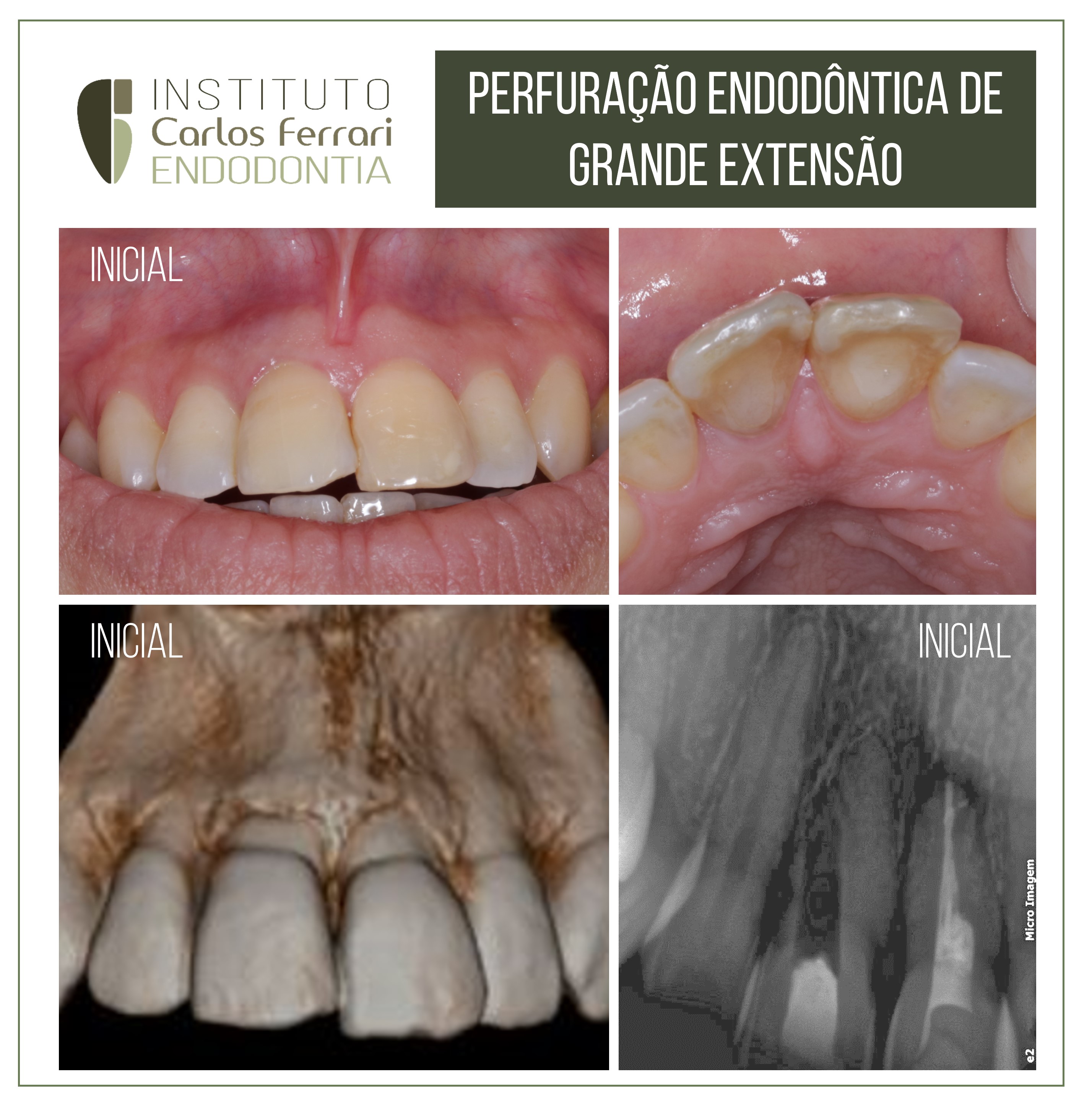 Perfuração endodôntica de grande extensão.