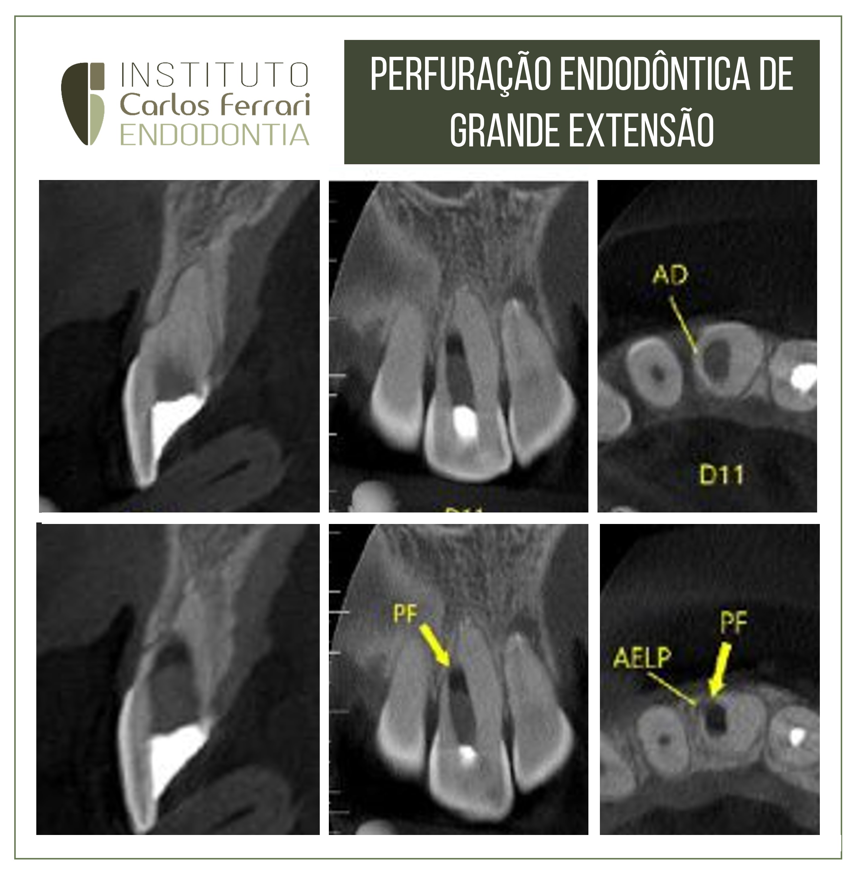 Perfuração endodôntica de grande extensão.