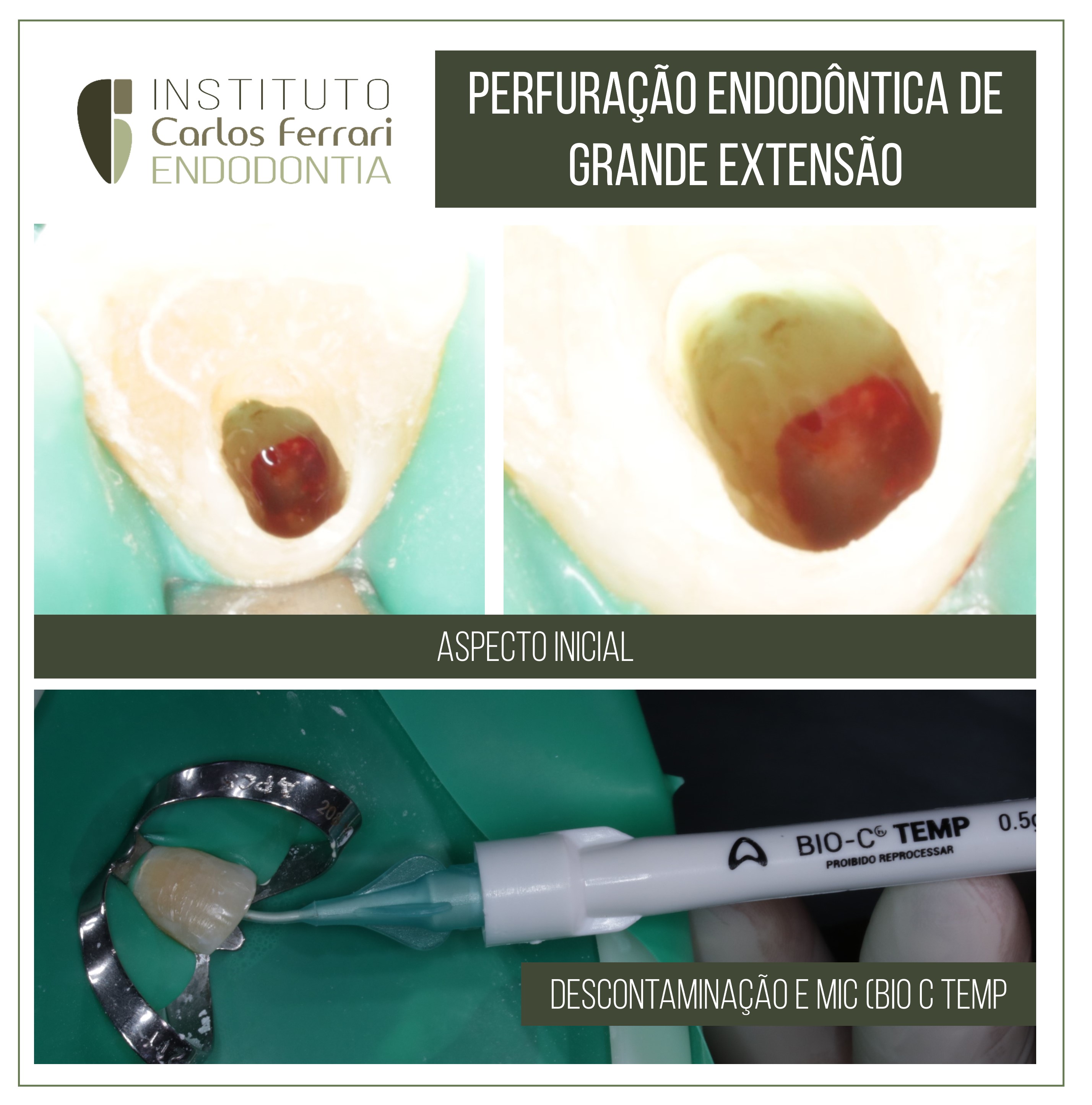 Perfuração endodôntica de grande extensão.