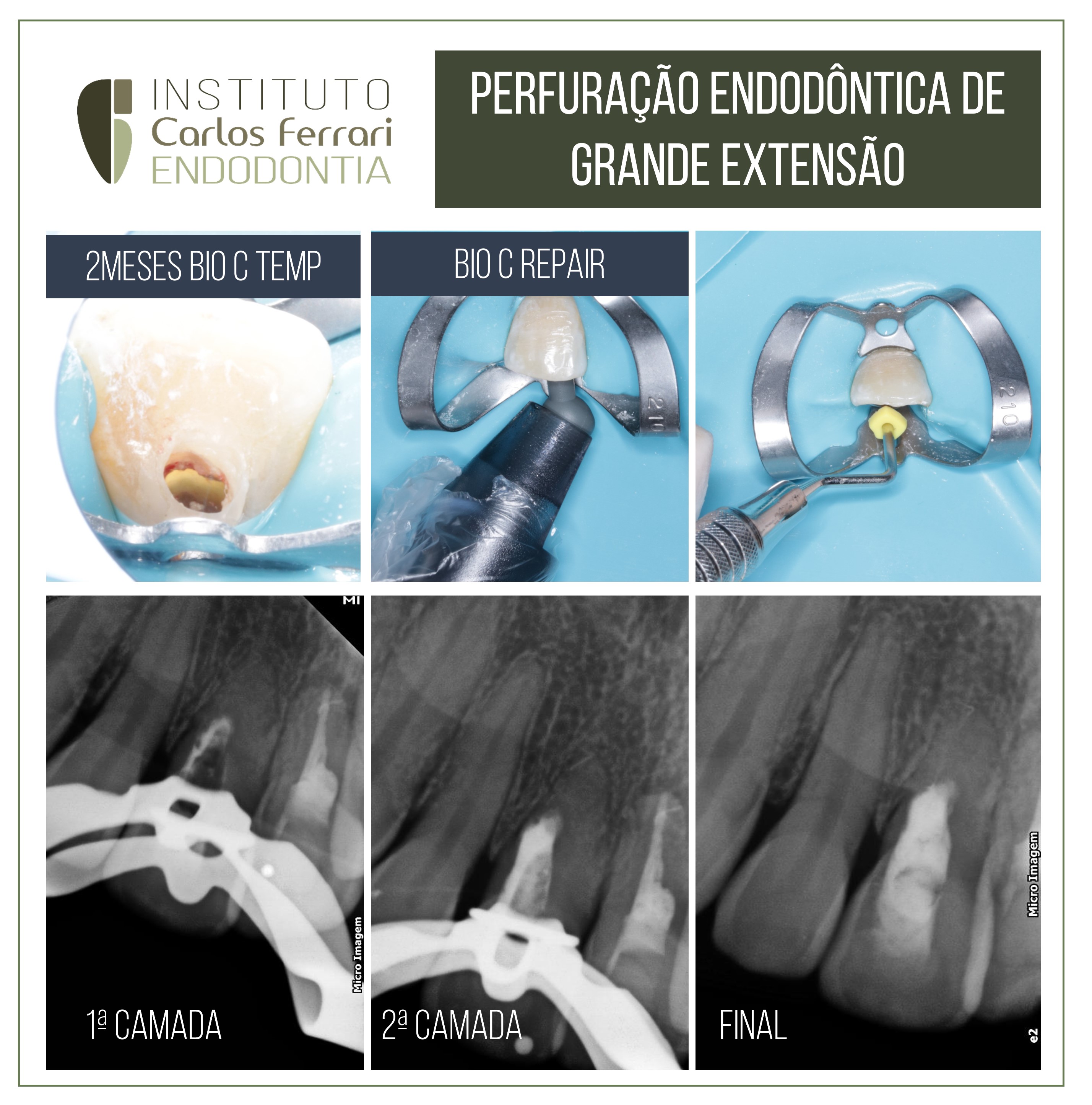 Perfuração endodôntica de grande extensão.