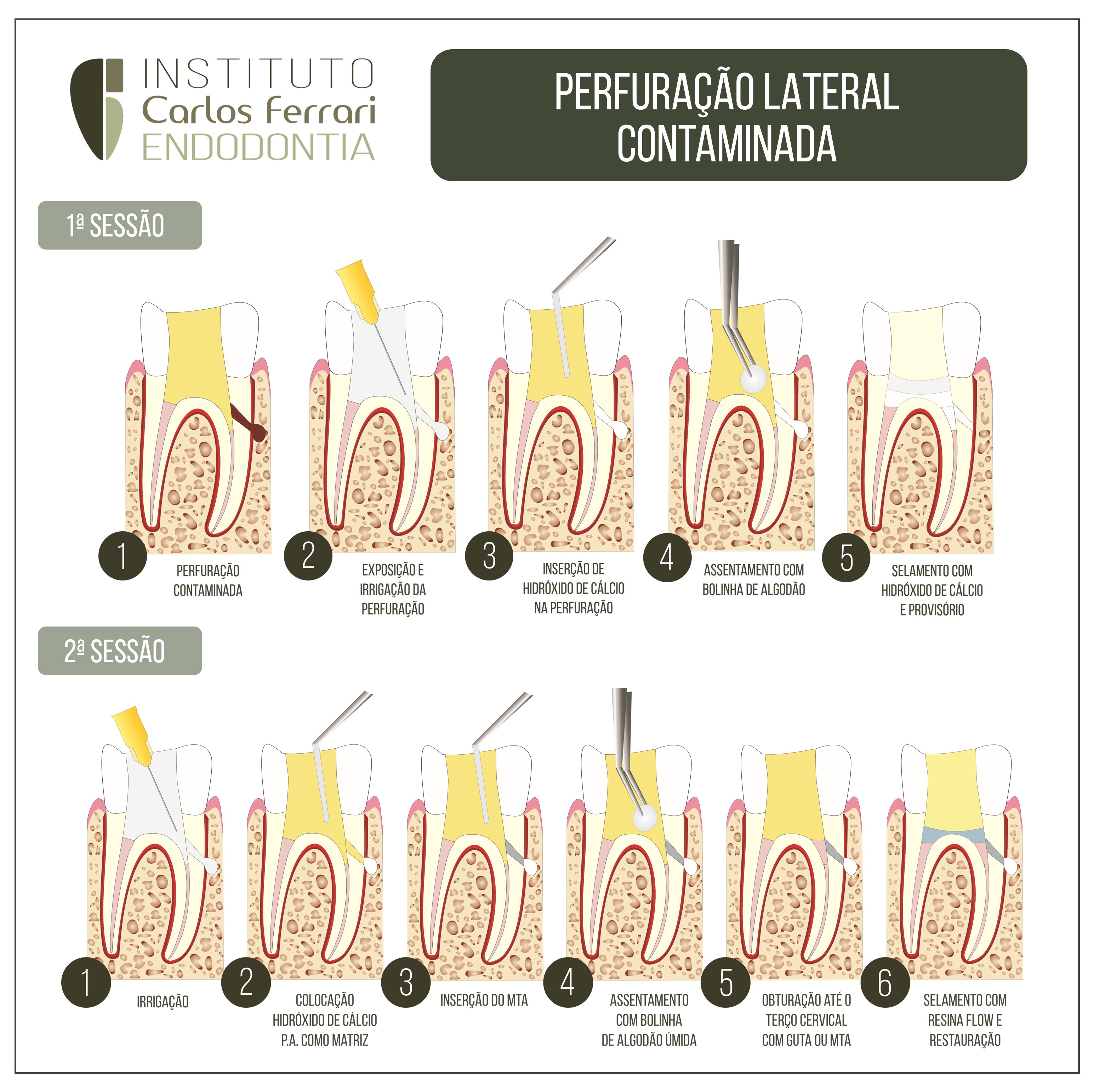 Perfuração radicular lateral contaminada. O que fazer?