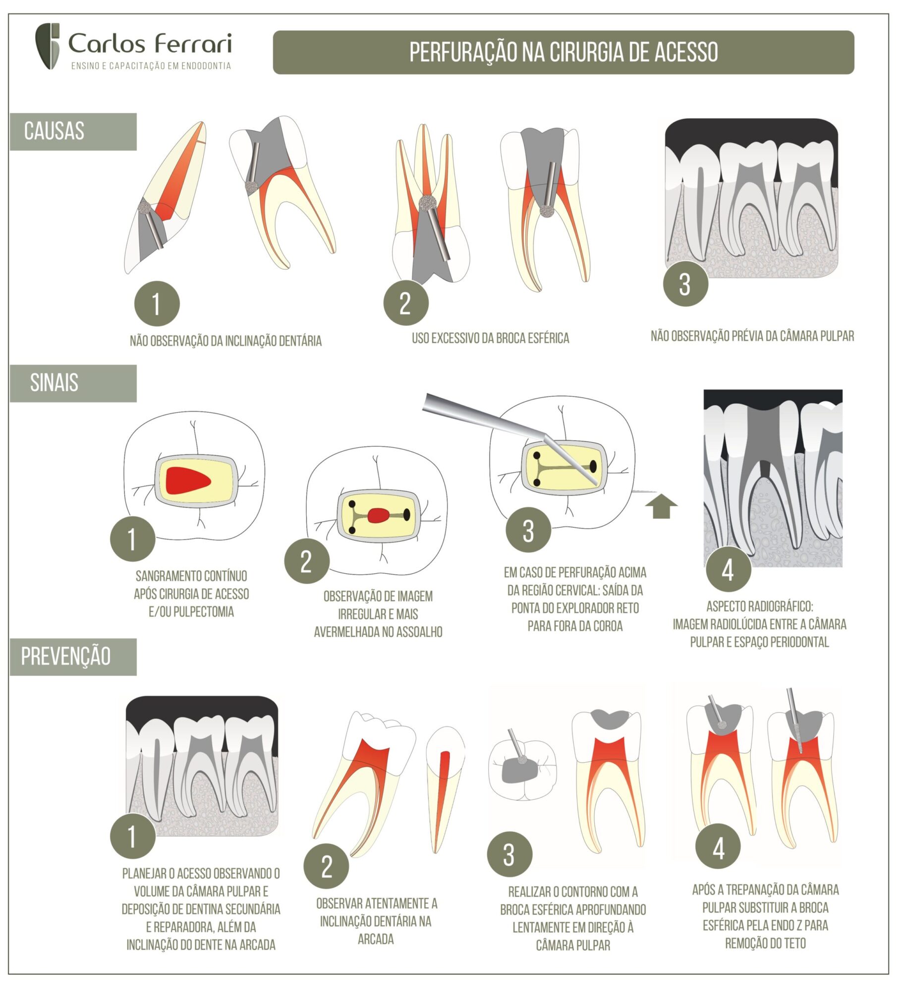 Perfuração na cirurgia de acesso.