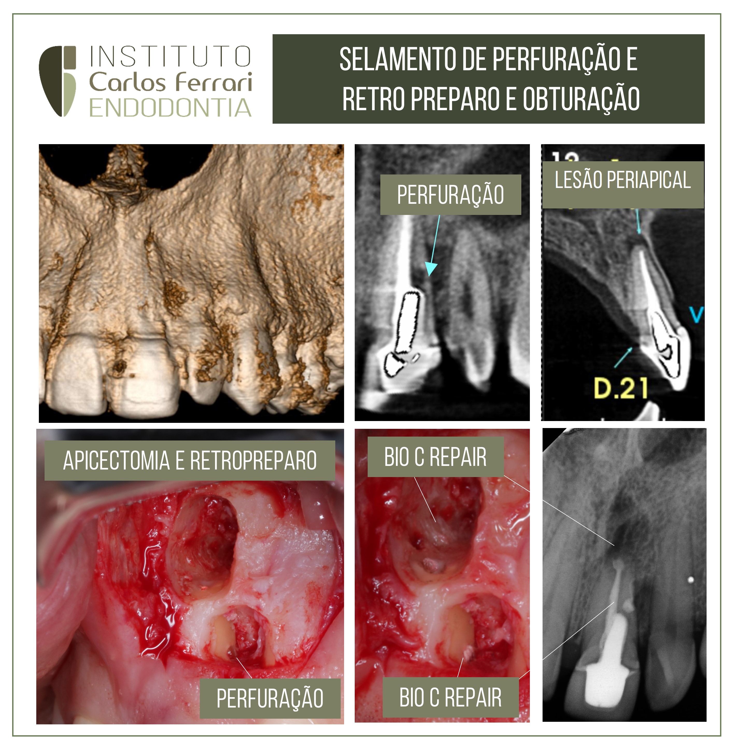Perfuração radicular e biocerâmico