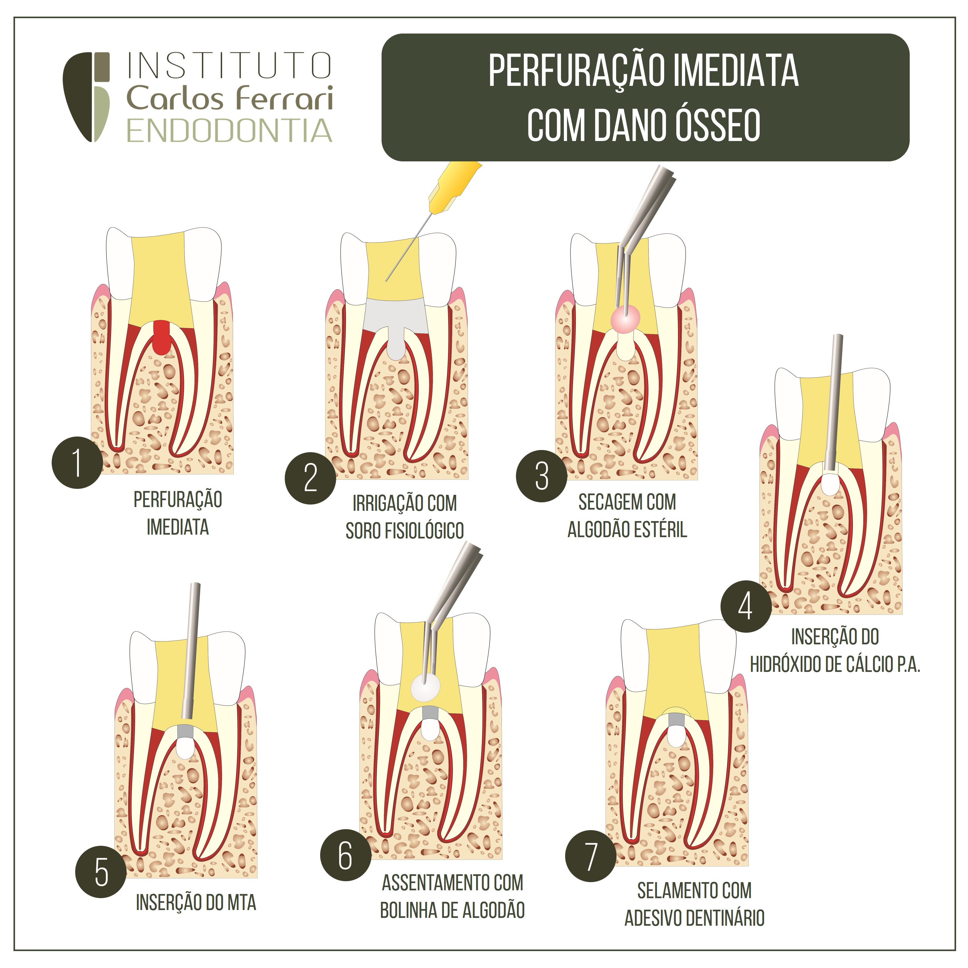 Perfuração radicular com dano ósseo. O que fazer?