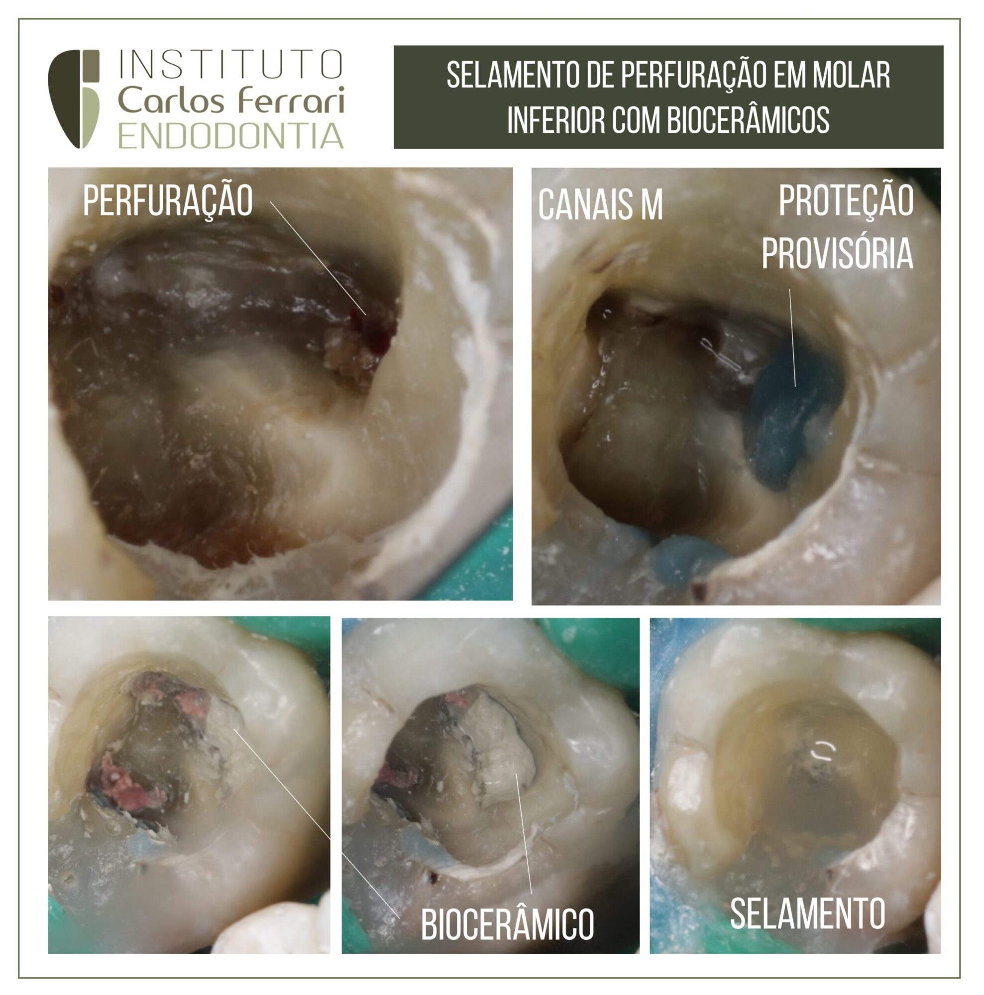 Perfuração selada com cimento biocerâmico